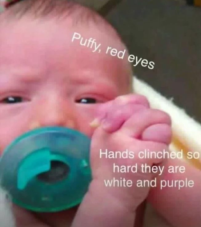 Infant face showing acute distress; eyes narrowed and expression tense.